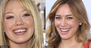 Celebrity dental implants before and after